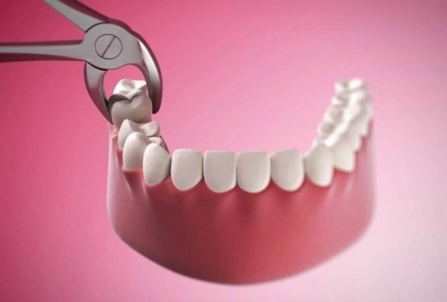Sau nhổ răng cần uống thuốc gì?