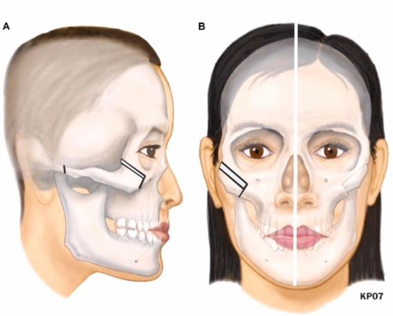 Sau phẫu thuật gãy xương gò má và gãy mỏm vẹt khó há miệng nên làm gì?