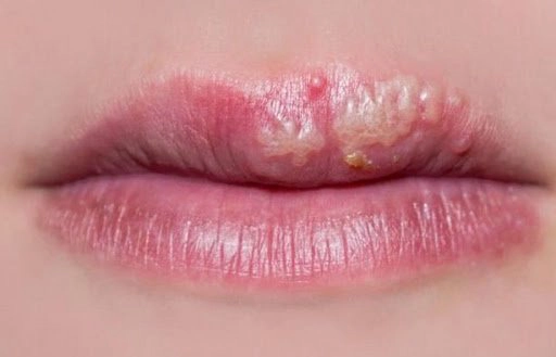 Sau xăm môi bị rộp môi uống thuốc gì?
