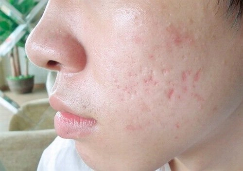 Sẹo lõm do thủy đậu điều trị thế nào?