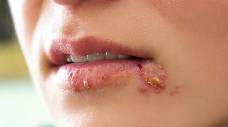Sẹo sau khỏi Zona nên dùng thuốc nào điều trị?