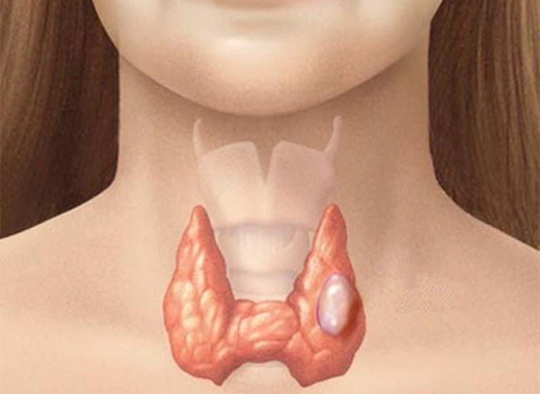 Siêu âm tuyến giáp có nang ở thùy eo có nguy hiểm không?