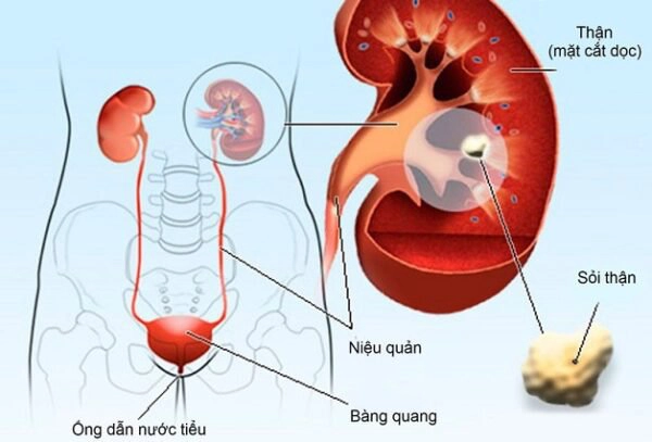 Sỏi niệu quản 12mm kèm viêm có nên phẫu thuật không?