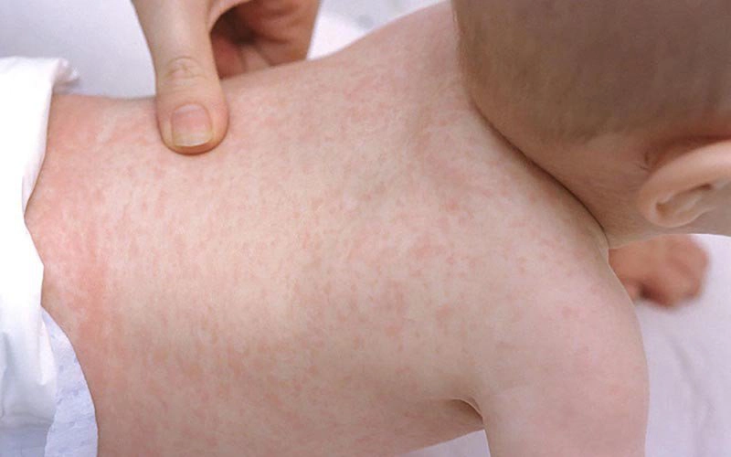 Sốt siêu vi ở trẻ em kéo dài mấy ngày?
