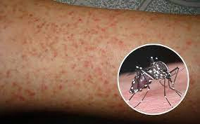 Sốt xuất huyết kèm ho, ngứa họng có sao không?