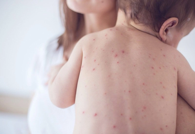 Sốt xuất huyết ở trẻ em có nguy hiểm không?