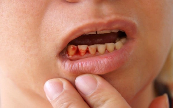 Sưng kèm chảy mủ lợi sau té đập răng phải làm sao?
