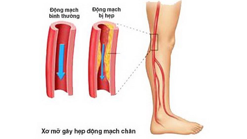 Tắc động mạch nuôi chi cấp tính có nguy hiểm?