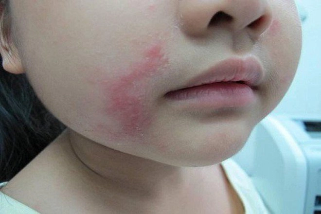 Tác hại khi bị kiến ba khoang cắn