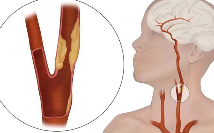 Tắc hoàn toàn động mạch cảnh trái phải điều trị thế nào?