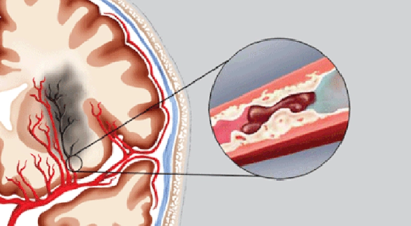 Tắc mạch máu não có hồi phục được không?