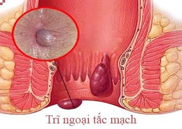 Tắc mạch trĩ là gì ? Điều trị như thế nào?