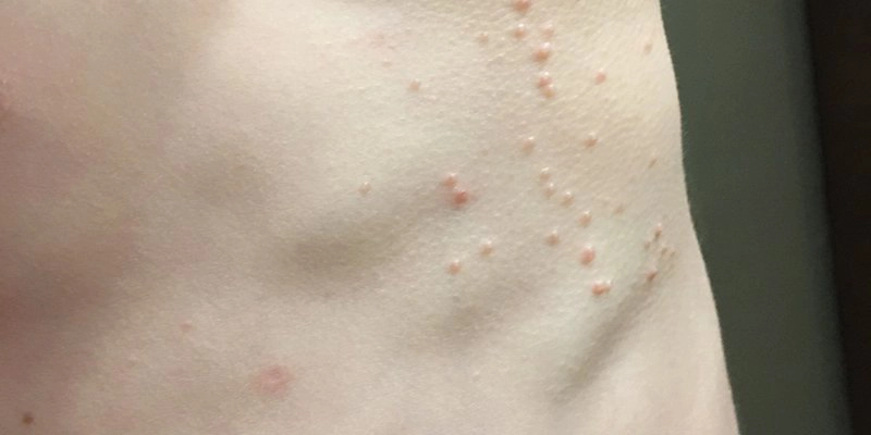 Tại sao u mềm lây dễ nhầm lẫn với các bệnh ngoài da khác