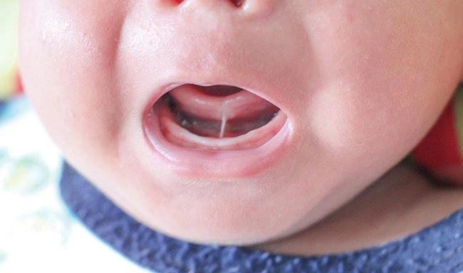 Tật dính thắng lưỡi ở trẻ sơ sinh