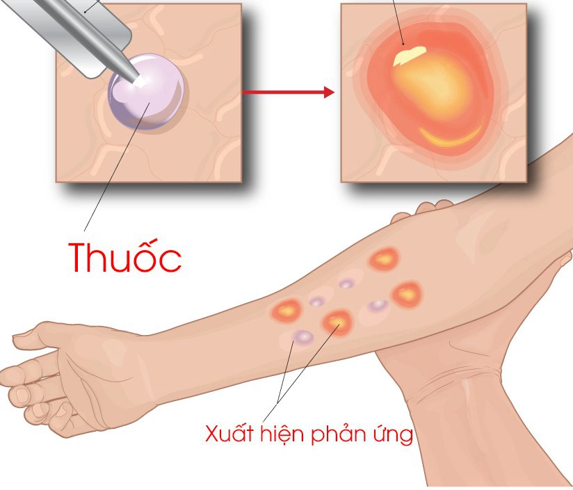 Test da giúp phát hiện dị ứng