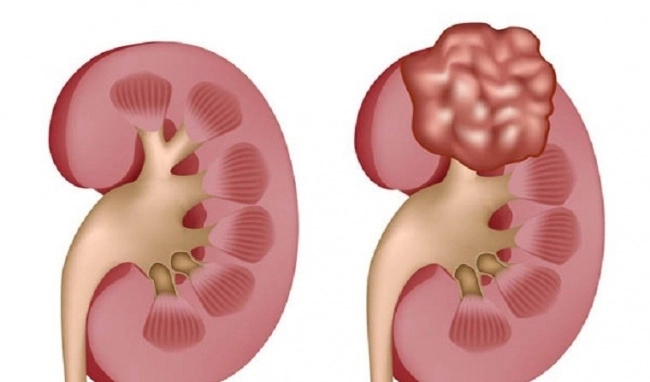 Thận đa nang tự phát (ADPKD) được điều trị như thế nào?