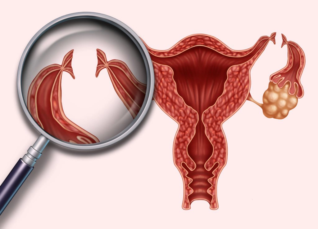 Thắt ống dẫn trứng để triệt sản nữ có đau không?