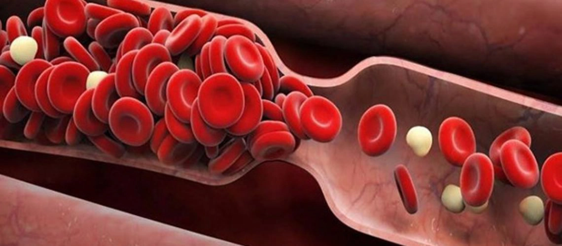 Thế nào là can thiệp nội mạch trong điều trị các bệnh lý mạch máu não?
