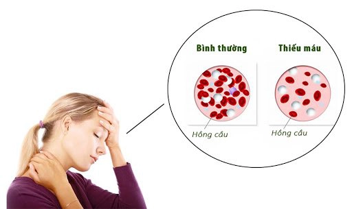 Thiếu máu thiếu sắt ảnh hưởng thế nào tới sức khỏe?