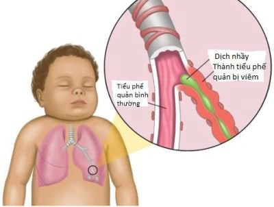 Thở rít ở trẻ nhỏ: Lưu ý mềm sụn thanh quản