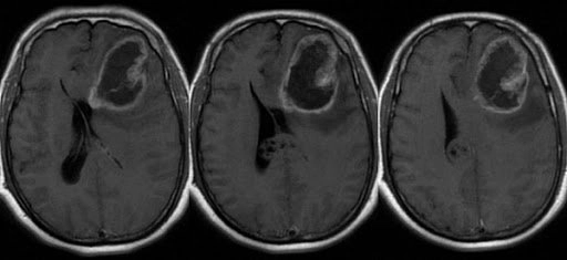 Thông tin về Gliomas (u thần kinh đệm) ở người lớn