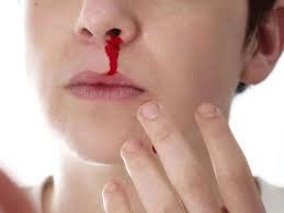 Thường xuyên chảy máu mũi là dấu hiệu của bệnh gì?