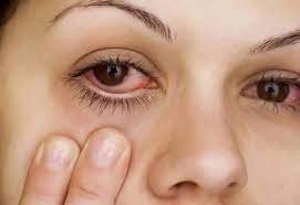 Thường xuyên đau ngứa mắt kèm đỏ mắt dấu hiệu bệnh gì?