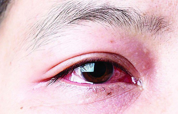 Thường xuyên đau nhức mắt kèm đỏ điều trị được không?