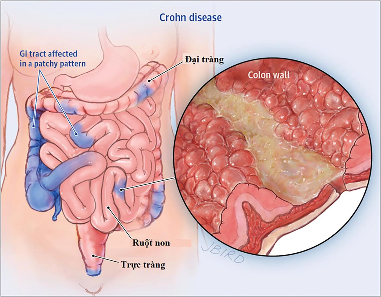 Tiên lượng và điều trị bệnh Crohn