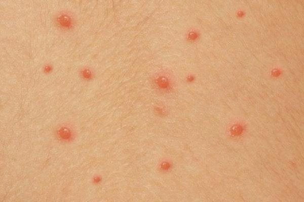 Tiếp xúc với người mới mắc thủy đậu có lây nhiễm không?
