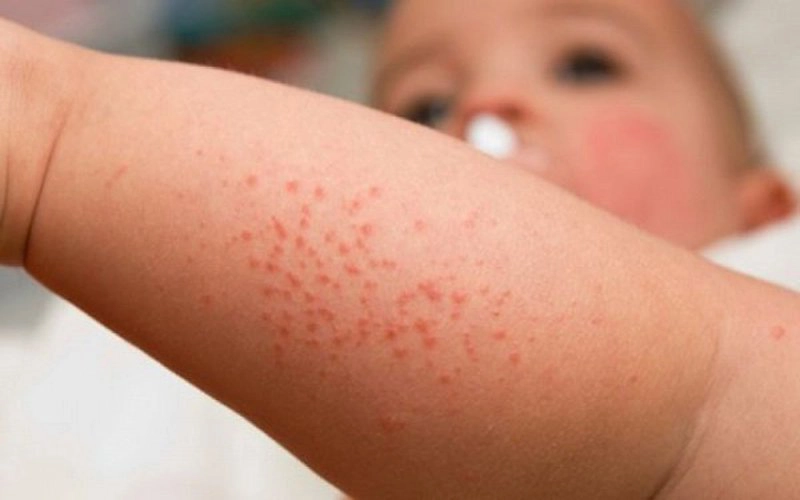 Tìm hiểu rối loạn giảm tiểu cầu ở trẻ em