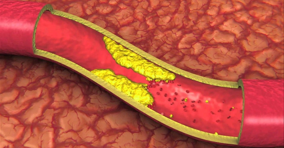 Tìm hiểu về các xét nghiệm lipid máu