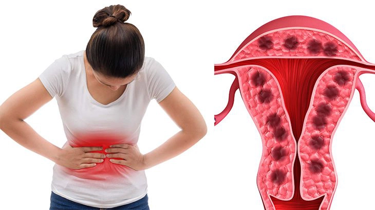 Tìm hiểu về lạc nội mạc trong cơ tử cung
