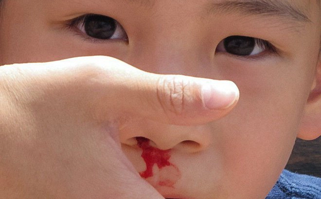 Tránh sặc nếu bị chảy máu mũi khi ngủ