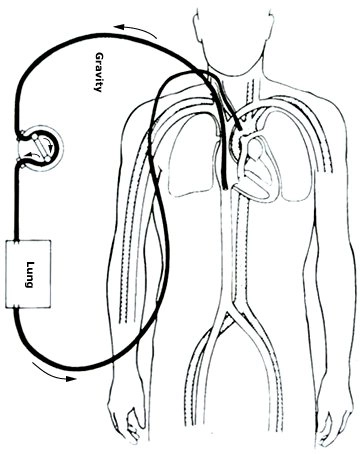 Trao đổi oxy qua màng ngoài cơ thể (ECMO)