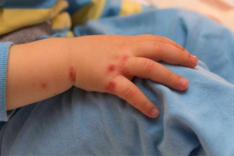 Trẻ bị tay chân miệng có ngứa không?