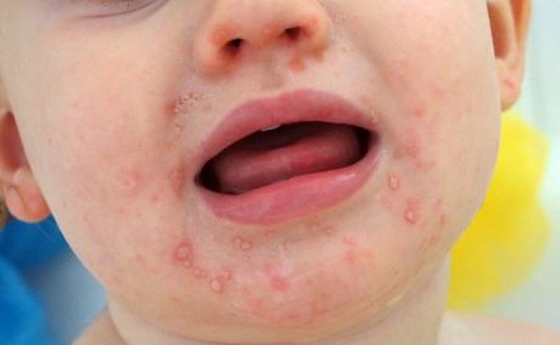 Trẻ bị tay chân miệng nên tắm lá gì?