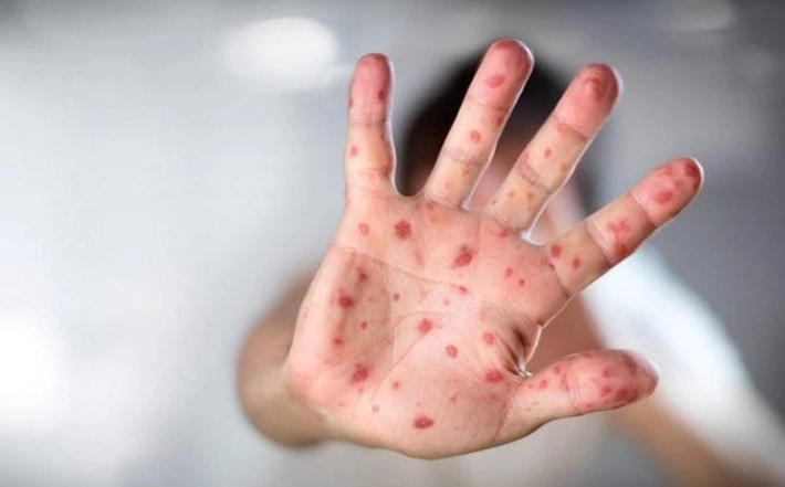 Trẻ có thể mắc tay chân miệng mà không sốt, không phát ban?