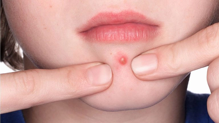 Trẻ dậy thì bị mụn có tự hết?
