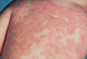 Trẻ dị ứng đạm sữa bò có nguy hiểm không?