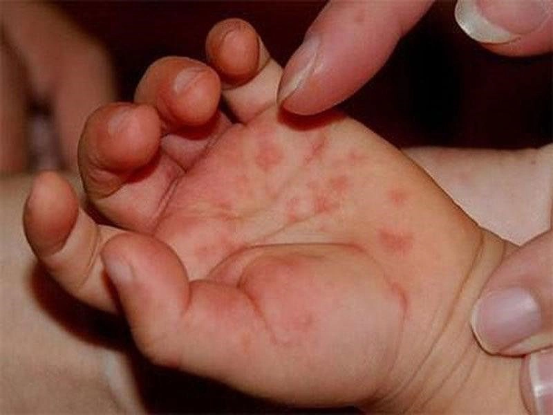 Trẻ hay giật mình khi bị tay chân miệng có phải do biến chứng?