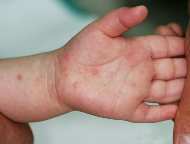 Trẻ mắc tay chân miệng nổi mụn nước nhiều có sao không?