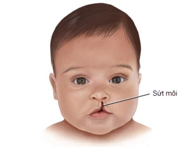 Trẻ sơ sinh bị sứt môi nhẹ có cần phẫu thuật?