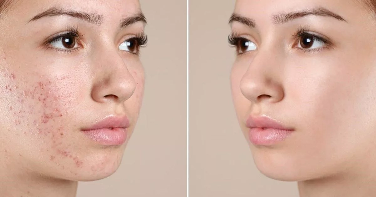 Trị mụn trứng cá bằng kem đánh răng - hiệu quả không?