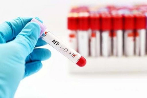 Tư vấn kết quả xét nghiệm định lượng AFP?