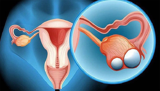 U túi noãn hoàng buồng trứng: Triệu chứng và cách điều trị