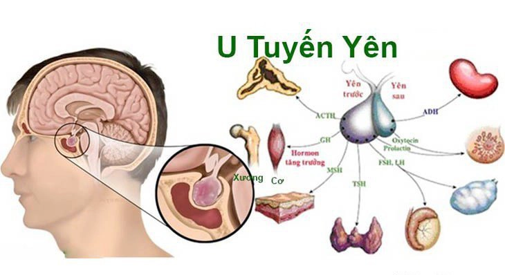 U tuyến yên tăng tiết prolactin là gì?