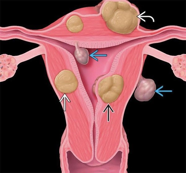 U xơ tử cung ở tuổi tiền mãn kinh: Nguyên nhân và cách điều trị