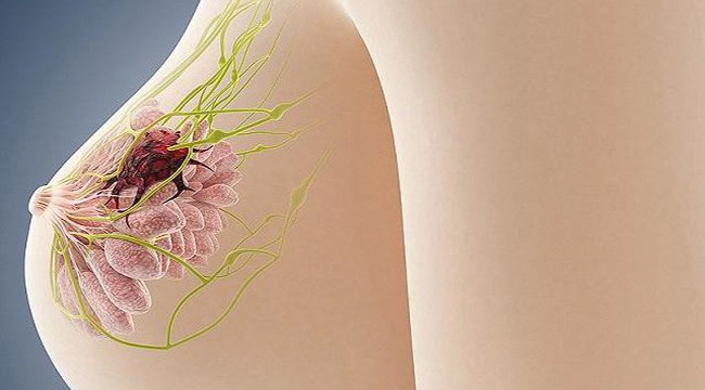 U xơ vú lành tính có nên mổ?