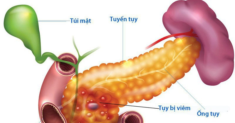 Vai trò của phản ứng miễn dịch bẩm sinh và xơ hóa storiform trong viêm tụy tự miễn ở người